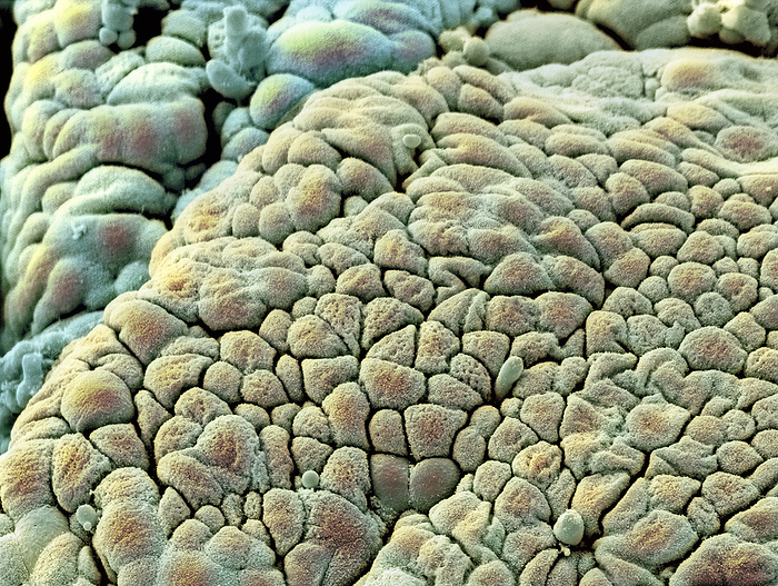 Rectal polyp surface, SEM Rectal polyp. Coloured scanning electron micrograph  SEM  of the surface of a rectal polyp. The rectum is the end portion of the intestines. Polyps are small benign  non cancerous  growths that arise from the mucous lining of the intestines. The surface of the polyp, the mucosa, consists of epithelial cells. The cause of most polyps is not known, although a diet high in animal fat and red meat and low in fibre, may be a risk factor. Some polyps are caused by diseases, such as familial polyposis or irritable bowel syndrome. Polyps should be surgically removed as they may become malignant  cancerous . Magnification: x1500 when printed 10 centimetres wide.
