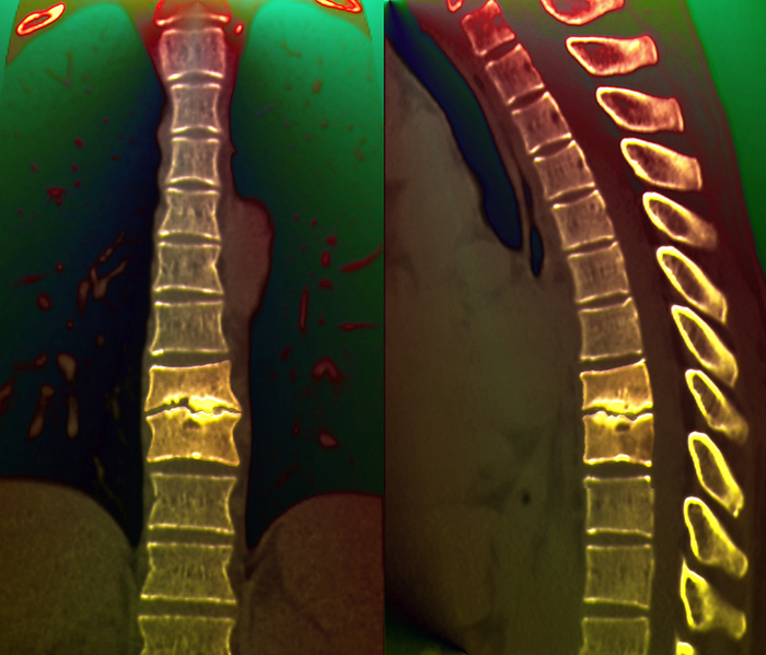 Infected spine, CT scan Infected spine. Coloured computed tomography  CT  scans of the spine of a 33 year old with spondylodiscitis, the infection of an intervertebral disc. A frontal view is at left and a side view at right. The affected area is bright yellow, between the eighth and ninth vertebrae  block of bone . The disc is inflamed and may be exerting pressure on the spinal cord, which would cause great pain. Treatment is with antibiotics and rest.