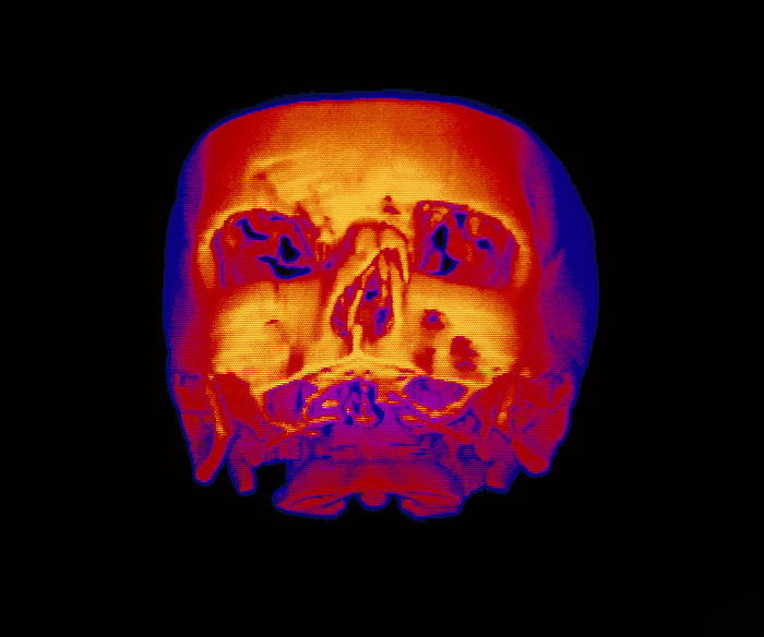 False colour 3 D CT scan of broken nasal bone Broken nose: false colour, three dimensional computed tomography  CT  scan of the skull of a patient with a fractured nasal bone. The damaged nasal bone appears asymmetric, with a V shaped notch on the right side. Full frontal view.