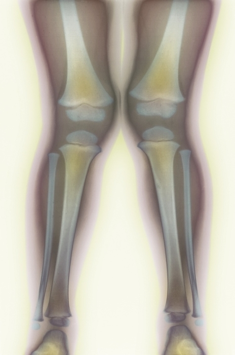Knock knee, X ray Knock knee. Coloured X ray of the legs of a 2  year old child suffering from knock knee, also known as genu valgum. This condition causes the inward curving of the legs so that the knees touch, and the feet are displaced outwards. It is common between the ages of three to five years  in children it usually requires no treatment unless it persists after the age of ten. Common causes are rickets, osteoarthritis, or bone fracture in the knee area. Heel wedges in shoes may help correct the line of the leg but most people require orthopaedic surgery  osteotomy , in which each tibia bone is cut and realigned to straighten the legs.