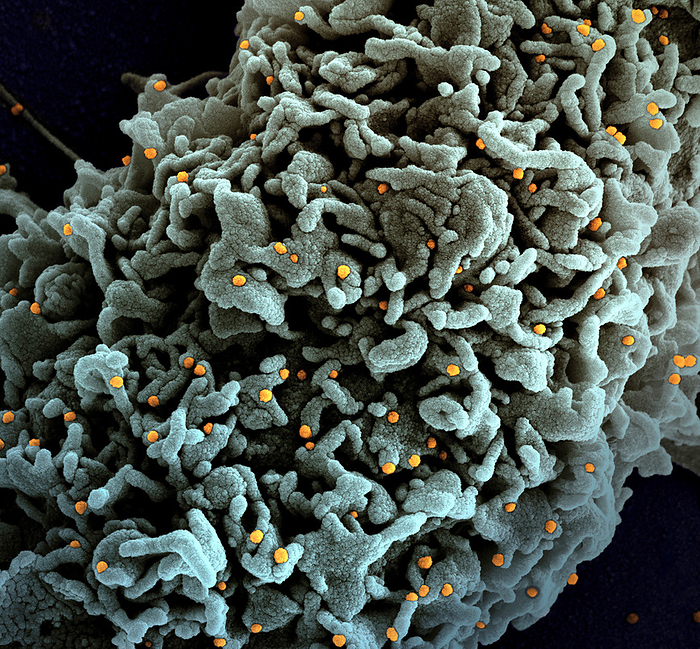 Cell infected with B.1.1.7 variant coronavirus, SEM Coloured scanning electron micrograph  SEM  of a cell  teal  infected with B.1.1.7 variant Covid 19 coronavirus particles  orange  isolated from a patient. Covid 19 is a respiratory infection that can lead to fatal pneumonia. It first emerged in Wuhan, China, in December 2019. The B.1.1.7 variant was first identified in the UK in December 2020 and has since been found in other countries. B.1.1.7 spreads between people much more quickly than other strains, but does not appear to cause more severe disease., by NATIONAL INSTITUTES OF HEALTH SCIENCE PHOTO LIBRARY