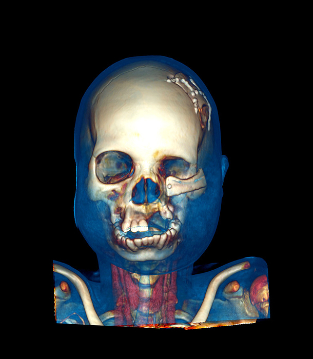 Facial reconstruction, CT scan Facial reconstruction, CT scan. Coloured 3 D computed tomography  CT  scan of a child who has had facial reconstruction, frontal view. The child is suffering from noma  cancrum oris . This infectious disease mainly affects children from developing countries. It is a form of gangrene that causes severe bone and tissue loss around the face. Noma has a high mortality rate if left untreated. The scan shows reconstructive surgery, in the form of bone from the top of the skull  calvarium flap  that has been grafted onto the left cheek. This image was produced using a multi  slice CT scanner, which uses a thin X ray beam to scan around the patient. OsiriX medical imaging software was used to produce coloured 3 D images which can be animated.