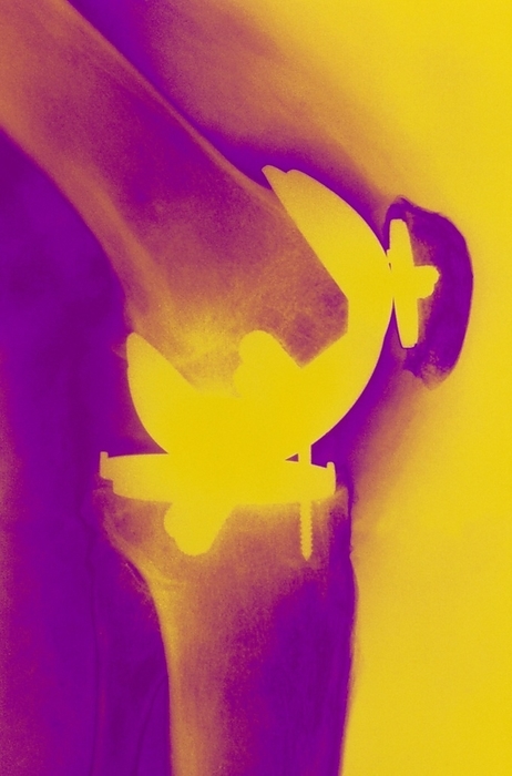 Coloured X ray of prosthetic knee joint, side view Prosthetic knee. Coloured X ray of a knee joint with an artificial or prosthetic joint  yellow . Knee joint replacement is most often carried out in older people whose knees are severely affected by osteoarthritis or rheumatoid arthritis. Arthritis is a general term used to describe inflammation of the joints. It affects joints symmetrically: joints of the feet, knees, ankles, hips, fingers, wrists and shoulders are affected. Rheumatoid arthritis is an autoimmune condition diagnosed by a blood test that reveals the presence of the rheumatic factor, and by X  rays that show typical erosion of the joints.