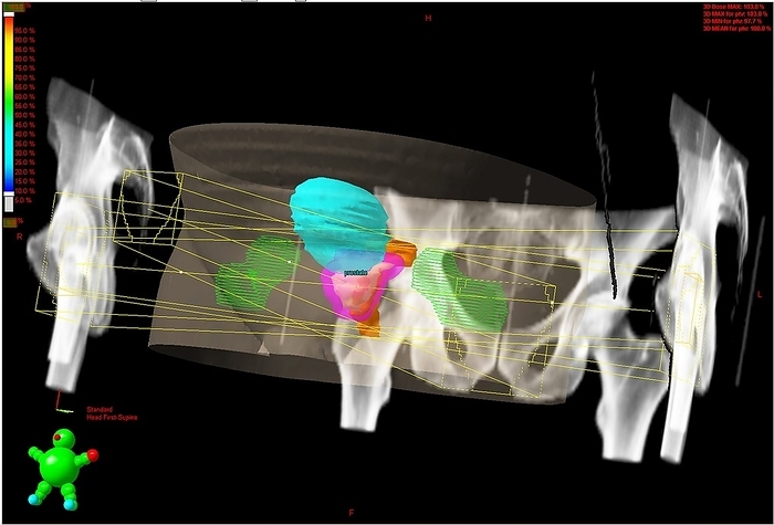 Cancer treatment plan, screenshot Cancer treatment plan. Screenshot of a radiotherapy treatment plan for targeting prostate cancer  pink  using a linear accelerator. Linear accelerators are used in radiotherapy as a source of high voltage X rays, which can deliver a precisely targeted dose of radiation to treat some cancers. Here, the design is for three differently angled beams to converge on the tumour. Also seen are the heads of the femurs, or thigh bones,  green , the bladder  cyan  and the rectum  brown .