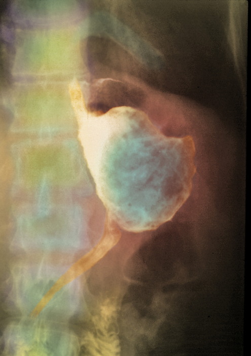 Stomach cancer treatment, X ray Stomach cancer treatment. Post operative coloured X  ray of a patient s digestive system, having undergone a gastrectomy as a result of stomach cancer. The procedure was an anastomosis  Billroth I gastrectomy , which removed part of the stomach and connected the remaining portion  centre, green  to the start of the small intestine  duodenum, centre to lower left, orange . If the cancer is detected early and the gastrectomy is successful, 85  of patients survive over five years. In more advanced and inoperable cases, radiotherapy and anticancer drugs are used to prolong life.