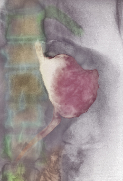 Stomach cancer treatment, X ray Stomach cancer treatment. Post operative coloured X  ray of a patient s digestive system, having undergone a gastrectomy as a result of stomach cancer. The procedure was an anastomosis  Billroth I gastrectomy , which removed part of the stomach and connected the remaining portion  centre, pink  to the start of the small intestine  duodenum, centre to lower left, pink . Stomach  gastric  cancers may cause pain, loss of appetite, nausea and weight loss. If the cancer is detected early and the gastrectomy is successful, 85  of patients survive over five years. In more advanced and inoperable cases, radiotherapy and anticancer drugs are used to prolong life.