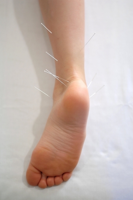 Acupuncture treatment, Severs Disease Acupuncture treatment. Acupuncture needles in the foot and lower leg of a 9 year old girl who has Sever s Disease. This syndrome is caused by stress and trauma on the heel bone of the foot during growth. It is thought to be the most common cause of heel pain in children between the ages of 7 and 15. Acupuncture is a traditional treatment, originating in China, that inserts needles into specific points in the body to relieve pain. The insertion of the needles is thought to trigger the release of endorphins, the body s natural painkillers.