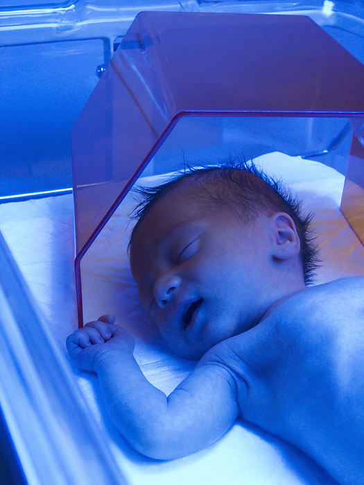 Neonatal jaundice light treatment Neonatal jaundice treatment. Baby in an incubator receiving blue light phototherapy to treat neonatal jaundice. Jaundice is a condition in which there is an excess of the yellow pigment bilirubin in the body s tissues, which causes yellow discolouration of the skin and eyes. Bilirubin is the breakdown product of haem, the oxygen carrying chemical in red blood cells. In neonatal jaundice, failure of the liver to process the bilirubin leads to its accumulation in tissues. This is very common in newborn babies, and is usually harmless. The blue light breaks down the pigment, allowing it to be excreted in faeces and urine. The hood over the baby s head protects its eyes from the light.