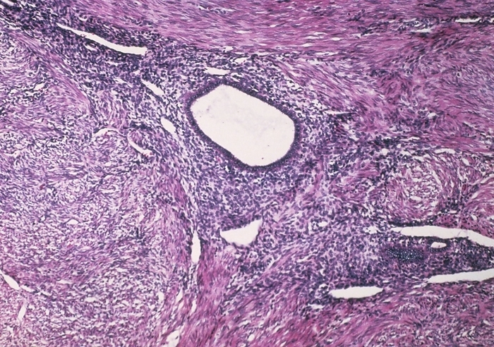 LM showing adenomyosis of human uterus Light micrograph showing adenomyosis of the human uterus, a term used to describe the abnormal presence of islands of endometrial glands and stroma deep within the myometrium  the muscle that supports the endometrium, the glandular uterine lining . Here, normal myometrium is stained pink, with displaced  ectopic  glands appearing white. The large gland at centre is surrounded by a purple staining area of stroma. Adenomyosis may result in the overall enlargement of the uterus or the local formation of a mass known as an adenomyoma. Ectopic endometrium responds to ovarian hormones, so its confinement by surrounding tissue may give rise to pain. FIG. 16.10 BASIC HISTOPATHOLOGY