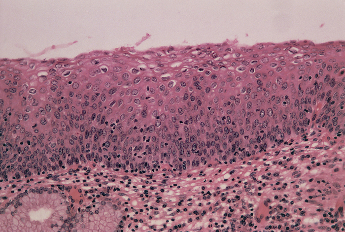 LM of cervical cells showing mild dysplasia  CIN1  Mild cervical dysplasia. Light micrograph of a section through human cervical epithelium showing mild dysplasia  abnormal growth  classified as CIN 1. CIN  cervical intraepithelial neoplasia  is the term used to describe malignant changes in the squamous epithelium of the cervix. Here, epithelial cells  upper half of section  have become thickened. Their nuclei  dark, round  have become enlarged and prominent. Cell division is not now confined to the basal  bottom  layer. If untreated such mild dysplasia can progress to cervical cancer, the most common type of cancer affecting women. Haematoxylin and eosin stained. Magnification: x200 at 35mm size.