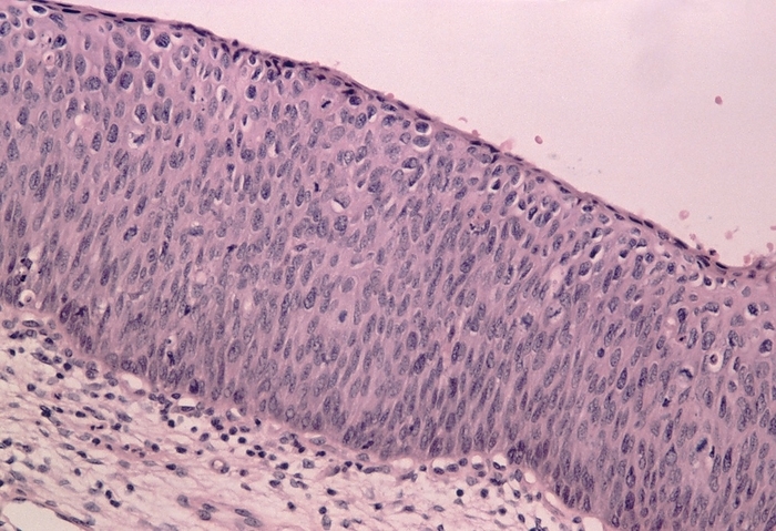 LM of cervix showing severe dysplasia  CIN 3  Severe cervical dysplasia. Light micrograph of a section through human cervical epithelium showing severe dysplasia  abnormal growth  classified as CIN 3. CIN  cervical intraepithelial neoplasia  is the term used to describe malignant changes in the squamous epithelium of the cervix. Here, epithelial cells  upper half of section  are highly dysplastic, being thickened with enlarged and prominent nuclei  dark, round . Cell division is not now confined to the basal  bottom  layer and dysplastic cells have migrated right to the surface. Such changes are referred to as carcinoma in situ. Haematoxylin and eosin stained. Magnification: x200 at 35mm size.