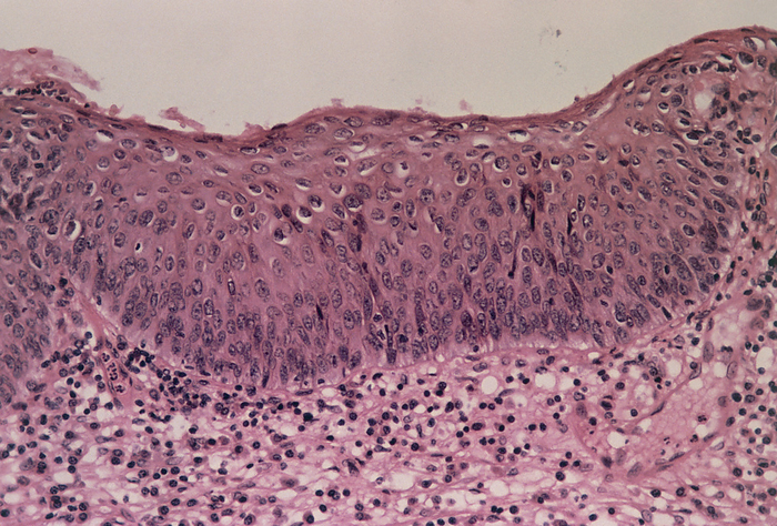LM of cervical cells with moderate dysplasia CIN 2 Moderate cervical dysplasia. Light micrograph of a section through human cervical epithelium showing moderate dysplasia  abnormal growth  classified as CIN 2. CIN  cervical intraepithelial neoplasia  is the term used to describe malignant changes in the squamous epithelium of the cervix. Here, epithelial cells  upper half of section  have become thickened. Their nuclei  dark, round  have become enlarged and prominent. Cell division is not now confined to the basal  bottom  layer and dysplastic cells have migrated upwards almost to the surface. If untreated moderate dysplasia can progress to cervical cancer. Haematoxylin and eosin stained. Magnification: x200 at 35mm size.