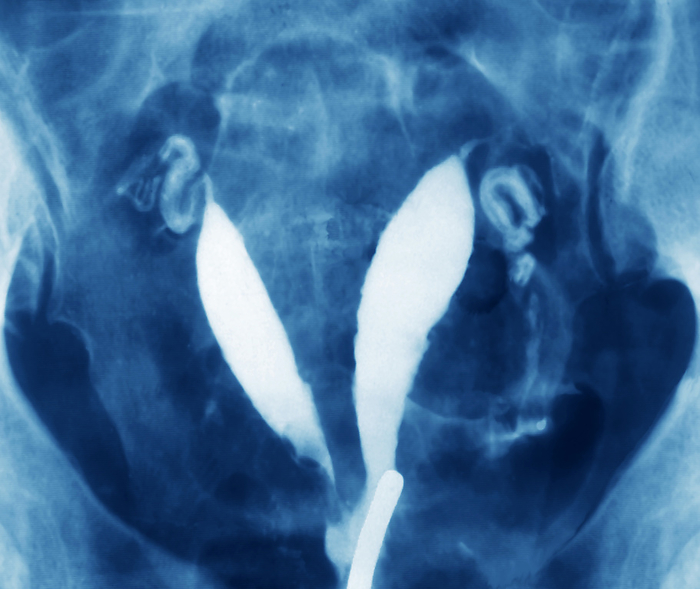 Deformed uterus, X ray Deformed uterus, X ray. This is a hysterosalpingo  graph, where a contrast medium has been injected into the abdomen, of a deformed uterus  white . The deformity resulted from incomplete development so that the uterus is made up of two hollow compartments. The Fallopian tubes or oviducts  twisting tubes, upper left and centre right  are also seen. Although the patient s ovaries function normally, it would not be possible for the patient to become pregnant. Reconstructive surgery may be possible, especially if irregular periods or heavier belding was experienced, there is no guarantee that this would allow a full term pregnancy to occur.