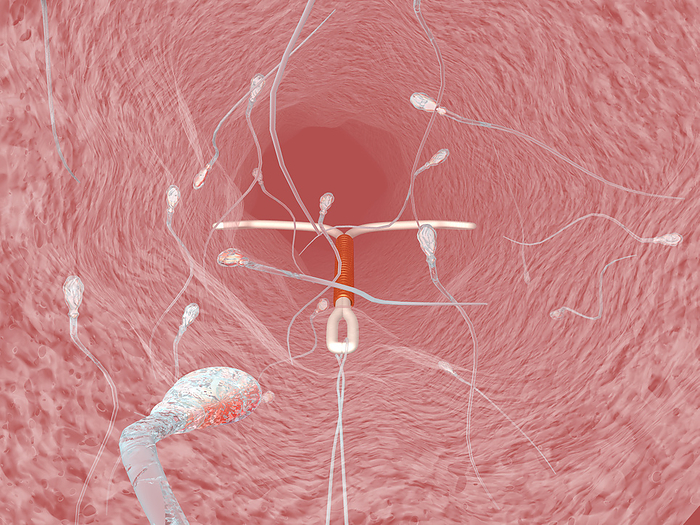 IUD contraceptive and sperm cells IUD contraceptive and sperm cells. Computer artwork of an intrauterine device  IUD, red and white, centre  in a woman s uterus, surrounded by sperm cells  white, not to scale . The IUD is a contraceptive device that is implanted in the uterus to prevent pregnancy. It does not interfere with the sperm cells  male reproductive cells , one of which may fertilise an egg cell  female reproductive cell . However, when a fertilised egg tries to implant in the wall of the uterus, the shape and material of the IUD disrupts this process. This IUD has a coil  red , made of a metal such as copper. If the implantation fails, the fertilised egg is lost during menstruation. This view looks upwards into the uterus. The loop and string at bottom are used to remove the IUD if it is no longer needed.
