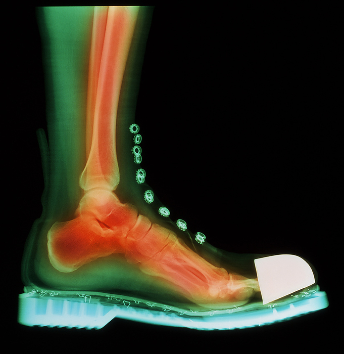 Coloured X ray of man s foot in a Doc Marten boot Foot in boot. Coloured X ray of a man s foot seen in side view, wearing a Doc Marten boot. The boot has a steel cap at the toes. Bones and soft tissues of the lower leg and foot are visible. The ankle  centre left  links the leg to the foot. The lower leg bones are the tibia and fibula. The foot comprises many bones, including the calcaneus  heel bone , several tarsal bones, five metatarsals, culminating in the phalanges bones of the toes. Doc Marten s are an English brand of boot and shoe.