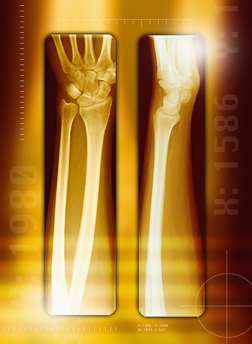 Healthy forearm, X rays Healthy forearm. Coloured X rays of a healthy forearm and wrist joint. A top view is at left and a side view is at right. There are two bones in the forearm, the radius  right  and the longer ulna  left . The ulna articulates with the humerus  upper arm bone  at the elbow and forms a small part of the wrist  carpus  joint. The radius forms the chief part of the wrist joint and only a small part of the elbow joint. There are eight wrist bones, known collectively as the carpal bones. From the carpal bones the five metacarpals extend into the hand.
