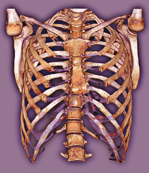 Rib cage, 3D CT scan Rib cage. Coloured frontal 3D computed tomography  CT  scan of a normal rib cage. Twelve pairs of ribs enclose the chest. They are attached at one end to the spine  backbone . The upper ribs are also attached to the breast bone  sternum, upper centre, in front of spine . The collar bones  clavicles  lie across the top of the rib cage and attach at one end to the breast bone and at the other ends to the shoulder bones. The shoulder blades  scapulas  and the head of the humerus  upper arm bone  are also seen, forming the shoulder joints.