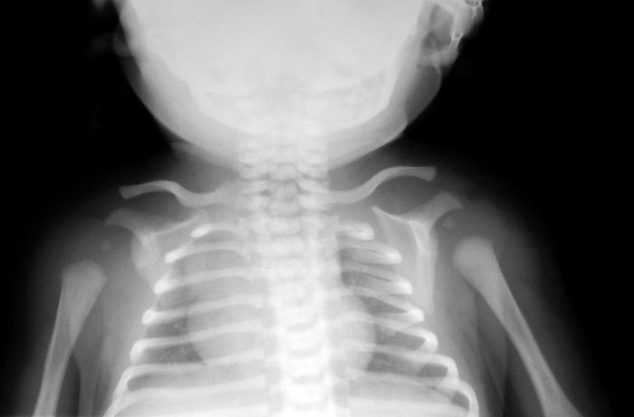 Young child, X ray X ray of a young child. X ray of the normal upper chest and shoulders of a young child. The collar bones  clavicles, horizontal below the skull  and shoulder joints show wide spaces between the bones, where bone growth and ossification  bone formation  must still take place to form the joints. As the child gets older, the bones will lengthen and ossify to be easily seen on X rays and the joint spaces will close to form the adult pattern. The lungs  black  are on either side of the heart  white, centre . The ribs  white, horizontal bands  protect the lungs and heart. The spine can also be seen running down the centre of the picture.