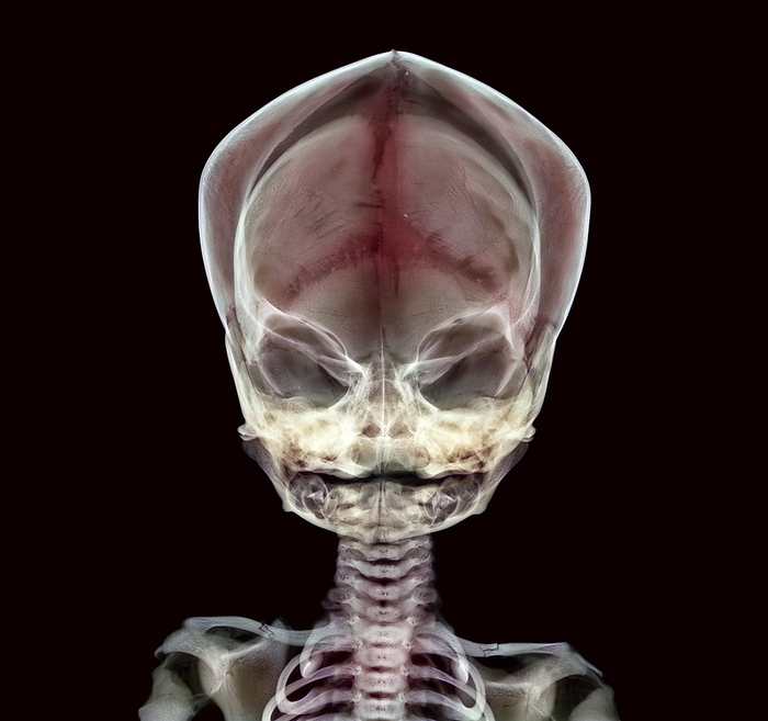 Child s skull Child s skull. Coloured X ray of a child s skull and shoulders. The cranium  upper centre  houses and protects the brain. The eye sockets and nasal cavity  centre  are also seen. The bones of the skull are yet to fuse together, indicated by the dark lines on the cranium. Both of the child s collar bones  clavicles, bottom left and right  have been broken, either as a result of an accident or abuse.