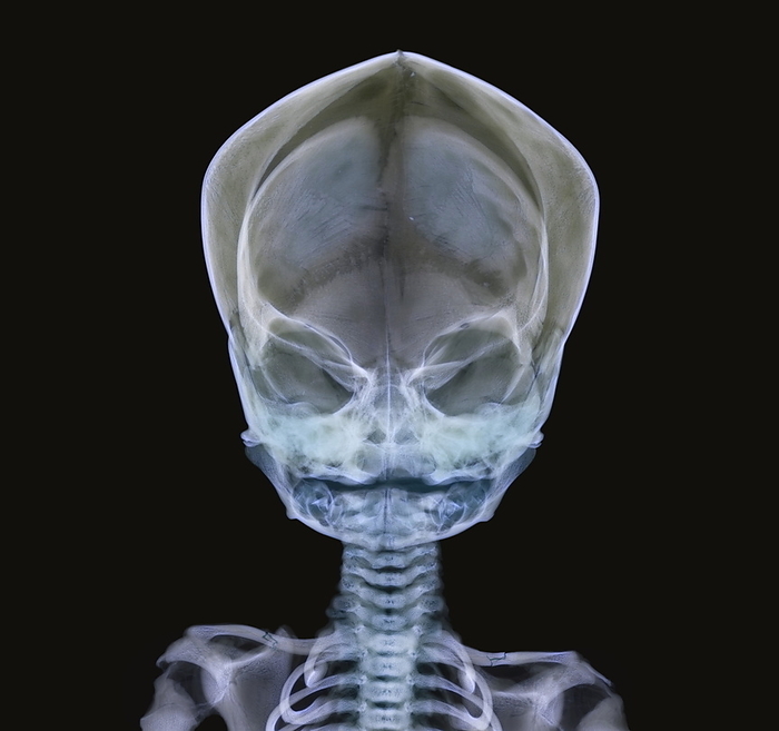 Child s skull Child s skull. Coloured X ray of a child s skull and shoulders. The cranium  upper centre  houses and protects the brain. The eye sockets and nasal cavity  centre  are also seen. The bones of the skull are yet to fuse together, indicated by the dark lines on the cranium. Both of the child s collar bones  clavicles, bottom left and right  have been broken, either as a result of an accident or abuse.