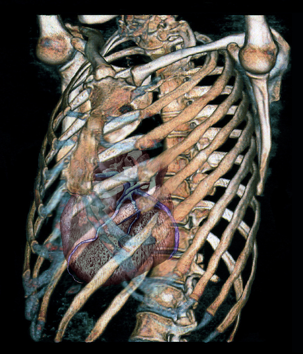 Heart and rib cage, 3D CT scan Heart and rib cage. Coloured 3D computed tomography  CT  scan of a normal heart and rib cage seen from an oblique side view. The heart  lower left, coronary arteries seen on its surface  is in the chest cavity formed by the ribs. Twelve pairs of ribs circle the chest. They are attached at one end to the spine  backbone, down centre , and at the other end to the breast bone  sternum, upper left . The breast bone helps provide extra protection for the heart. The two clavicles  collar bones  meet at the top of the breast bone. The head of each humerus  upper arm bone  is seen at top left and right, forming part of the shoulder joints. The tip  chin  of the lower jaw bone is also at upper left.