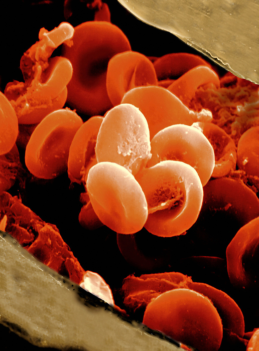 Red blood cells, SEM Red blood cells. Coloured scanning electron micrograph  SEM  of red blood cells  erythrocytes  flowing through a blood vessel. These biconcave, disc shaped cells transport oxygen through a network of blood vessels, from the lungs to all the cells of the body. They also remove carbon dioxide produced by cells in respiration and transport it back to the lungs to be exhaled. The red colour is due to haemoglobin, a protein compound that combines with the oxygen. Red blood cells are the most abundant cell in vertebrate blood. In humans they measure about 8 micrometres in diameter. Magnification: x3000 at 6x7cm size.