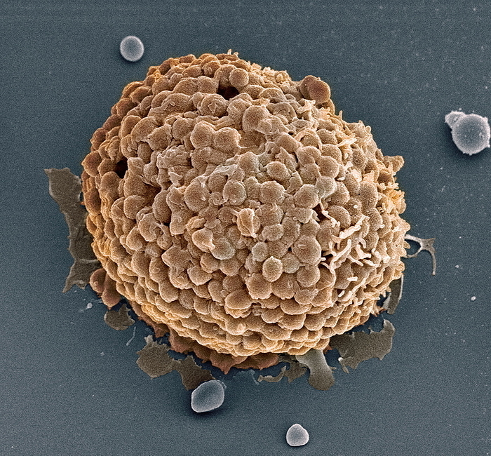 Mast cell, SEM Mast cell, coloured scanning electron micrograph  SEM . Mast cells are a type of white blood cell that are found in connective tissue. Within the cell s cytoplasm are granules containing chemical mediators, including histamine  grey granules  and heparin. When the mast cell is activated, either by an allergic reaction or in response to injury or inflammation, these granules are released into the tissues. Histamine is responsible for the symptoms of an allergic reaction. It causes pain and itching, dilates capillaries and makes them more permeable, leading to red skin and swelling. Heparin is an anticoagulant, it prevents blood from clotting. Magnification: x1750 when printed 10 centimetres wide.