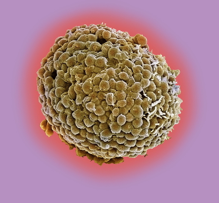 Mast cell, SEM Mast cell, coloured scanning electron micrograph  SEM . Mast cells are a type of white blood cell that are found in connective tissue. Within the cell s cytoplasm are granules containing chemical mediators, including histamine and heparin. When the mast cell is activated, either by an allergic reaction or in response to injury or inflammation, these granules are released into the tissues. Histamine is responsible for the symptoms of an allergic reaction. It causes pain and itching, dilates capillaries and makes them more permeable, leading to red skin and swelling. Heparin is an anticoagulant, it prevents blood from clotting. Magnification: x1750 when printed 10 centimetres wide.