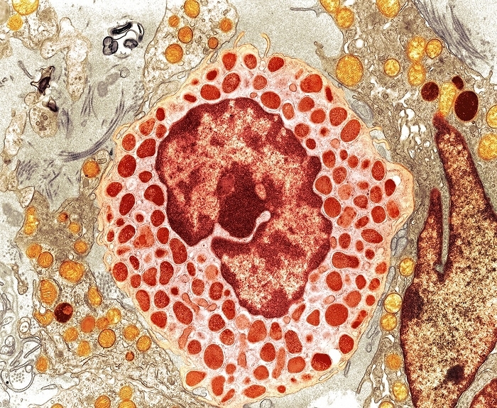Mast cell, TEM Mast cell, coloured transmission electron micrograph  TEM . Mast cells  mastocytes  are a type of white blood cell  leukocyte  found in connective tissue. The large oval  brown  is the cell s nucleus, which contains its genetic information. Within the cell s cytoplasm  pink  are granules  red  containing chemical mediators, including histamine and heparin. When the mast cell is activated, either by an allergic reaction or in response to injury or inflammation, these granules are released into the tissues. Histamine is responsible for the symptoms of an allergic reaction, such as itching, and heparin prevents blood from clotting. Magnification: x6,700 when printed at 10 centimetres wide.