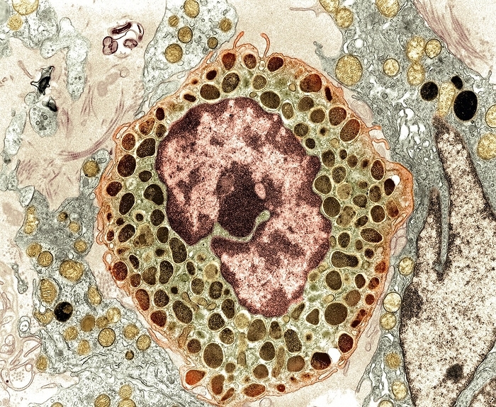 Mast cell, TEM Mast cell, coloured transmission electron micrograph  TEM . Mast cells  mastocytes  are a type of white blood cell  leukocyte  found in connective tissue. The large oval  pink and brown  is the cell s nucleus, which contains its genetic information. Within the cell s cytoplasm  green  are granules  brown  containing chemical mediators, including histamine and heparin. When the mast cell is activated, either by an allergic reaction or in response to injury or inflammation, these granules are released into the tissues. Histamine is responsible for the symptoms of an allergic reaction, such as itching, and heparin prevents blood from clotting. Magnification: x6,700 when printed at 10 centimetres wide.
