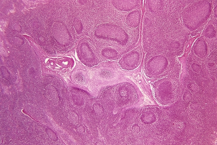 Light micrograph of human lymph node Lymph node. Light micrograph of a human lymph node. Lymph nodes are kidney shaped organs packed with white blood cells that destroy disease  causing microorganisms within the body. Fluid from body tissues drains through lymphatic vessels into the nodes to be filtered. The granular appearance of the tissue is caused by thousands of lymphocyte white blood cells packed together. The rounded structures within the node are called lymphoid follicles. These contain germinal centres where B lymphocytes proliferate. The pink tissue in the centre is fibrous connective tissue that provides structural support. Magnification x4 at 35mm size. Magnification: x12 at 6x9cm size.