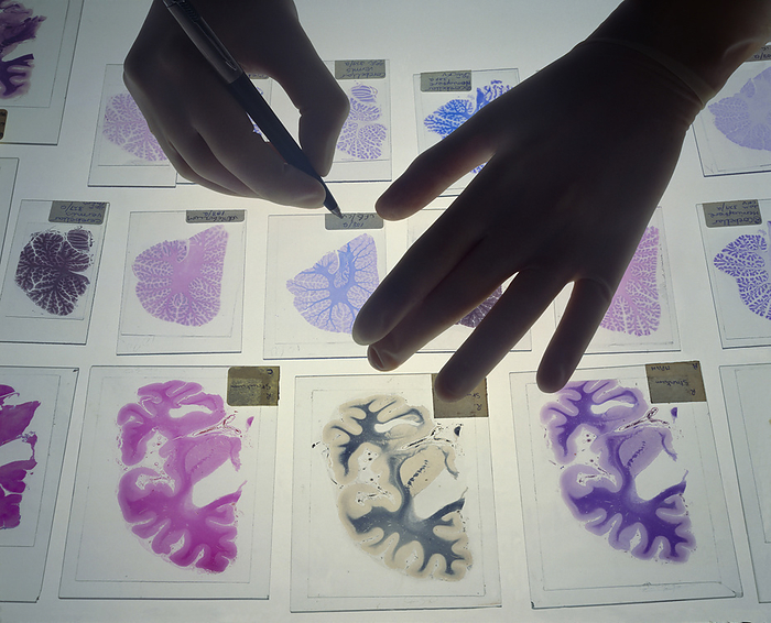 Gloved hands and human brain sections on light box Brain slices. Gloved hand writing on a microscope slide of a section through a human brain. The slide is amongst an assortment of other brain sections on a lightbox. The lower row of slides are coronal slices through the frontal region of the cerebrum. The cerebrum is the part of the brain involved with conscious thought and sensory processing. The other two rows of slides are sections through the cerebellum, which coordinates movement and balance. By examining brain slices under a microscope the health of the brain can be determined.