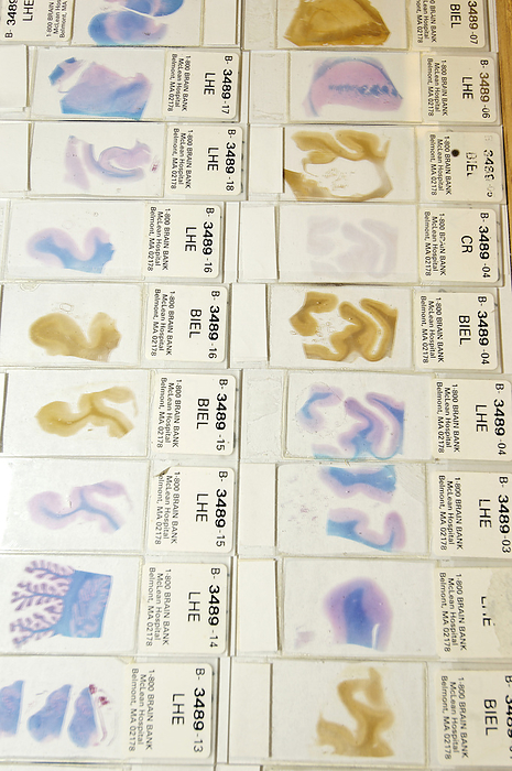 Human brain microscope slides Human brain microscope slides. Microscope slides of stained sections of human brain. These slides are from the Harvard Brain and Tissue Resource Centre, USA. This is the largest brain bank in the world. It stores over 3,000 brains, which are available to researchers studying disorders such as Alzheimer s disease, Parkinson s disease and schizophrenia.