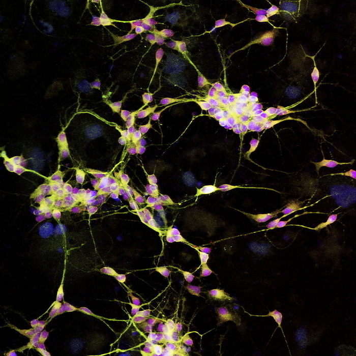 Nerve cell growth Nerve cell growth. Light micrograph of nerve cells  neurons  with immunofluorescent staining. These cells have been grown in culture. The stains show nerve cell bodies  pink  and the neurites  yellow, either axons or dendrites  that connect the cell bodies to form a network. Neurons transmit electrical signals around the body, especially the brain and the spinal cord. These neurons have been grown from NT2 cells, a human teratocarcinoma cell line capable of differentiation into nerve cells. Research like this may discover methods of neural regeneration that could treat spinal paralysis and other nerve disorders.