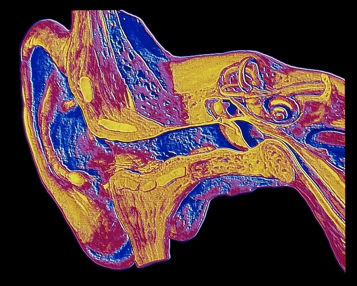 Computer graphic of the anatomy of the human ear Ear anatomy. Computer graphic of a section through the skull, showing the anatomy of the human ear. Sound waves are collected by the outer ear pinna  at left  and pass down the auditory canal to strike the eardrum  centre right . Vibrations of sound are transmitted via three tiny ear bones  malleus, incus and stapes  into fluid filled structures of the inner ear  upper centre right . Three coils of the semi circular canals detect balance and body orientation. While in the spiral shaped cochlea, tiny hair cells are sensitive to vibrations of the cochlear fluid and these cells activate the auditory nerve  far right  which is connected to the brain.