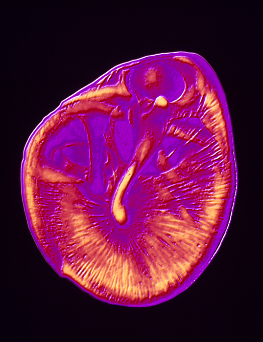 Human eardrum Eardrum. Computer graphic showing the human ear  drum  tympanic membrane . This membrane is oval in shape, the upper half containing more blood vessels than the lower half. It lies at the end of the external ear canal  auditory meatus , and separates the outer and middle ear regions. When sound waves strike the tympanic membrane, it vibrates. These vibrations are transmitted to the malleus, one of the middle ear bones. From the middle ear, vibrations pass into the inner ear where the cochlear translates them into nerve impulses. The eardrum is thus the first structure of the ear which transforms waves of sound into vibrations for the purposes of hearing.