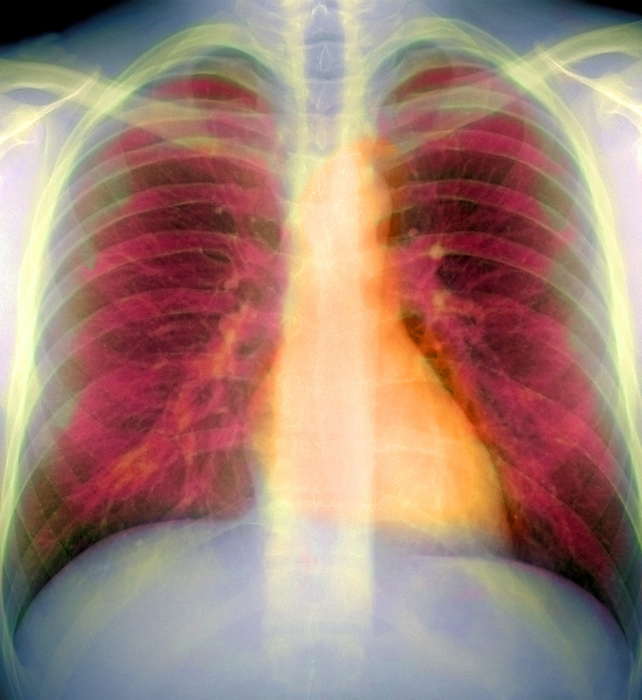 Lungs and heart, X ray Lungs and heart, coloured chest X ray. The lungs and heart are enclosed and protected by the ribs  horizontal bars  which meet at the breastbone, or sternum  down centre . The heart  orange  is seen protruding from behind the sternum at lower right. The lung airways  red  branch out into the rest of the chest cavity. The lungs bring air close to blood capillaries, allowing oxygen to be taken up by the body, and carbon dioxide to be released. The heart pumps blood around the body.
