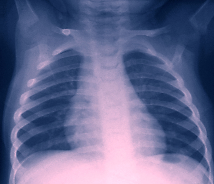 Healthy chest X ray Healthy chest X ray. Coloured frontal X ray of the chest of a healthy baby during inhalation  breathing in . The ribs are seen as a set of horizontal bands enclosing the lungs  dark areas either side of the spine , and the heart  pink mass, lower centre . During inhalation the ribs move up and to the sides to allow the lungs to expand and fill with air. The spinal column runs vertically down from the head  not seen . Chest X  rays are taken to diagnose diseases such as pneumonia, tuberculosis and lung cancer. These would show up as abnormal, shaded areas over the lungs.