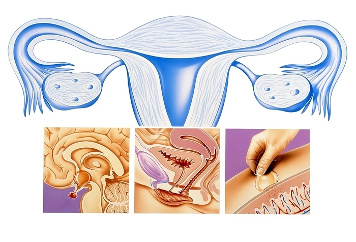 Menopause Menopause. Artwork showing various features associated with the menopause, the cessation of menstruation in women. The pituitary gland  red, lower left  controls the release of FSH  follicle  stimulating hormone , which prompts ovulation. It stops producing FSH at menopause. Some of the symptoms associated with the menopause include vaginitis, atherosclerosis   osteoporosis. An HRT  hormone replacement therapy  patch  lower right replaces hormones, through the skin, easing these symptoms.