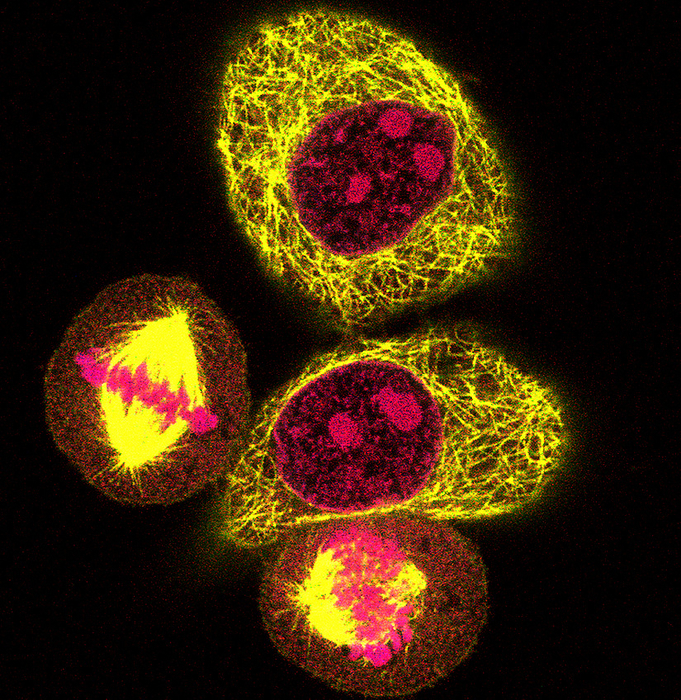 Mitosis, light micrograph Mitosis. Confocal light micrograph of HeLa cells during mitosis  nuclear division . Mitosis is the formation of two daughter nuclei from one parent nucleus. The cells at top and centre are in interphase, between divisions. The cell at left is in metaphase. The chromosomes  pink  are lined up along the centre of the cell. The cell at bottom is at the start of anaphase, the two identical chromatids that make up each chromosome are being separated to opposite poles of the cell. Microtubules, which are part of the cell s cytoskeleton, are yellow.