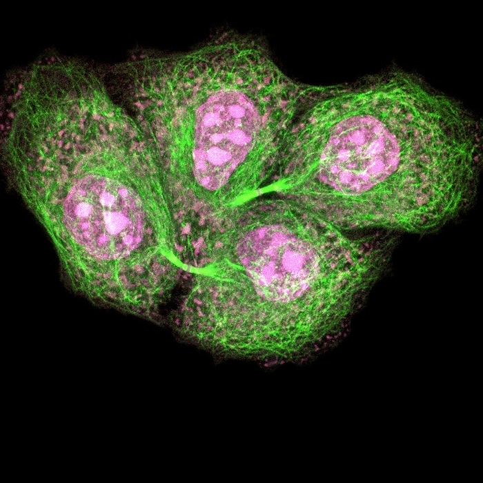 HeLa cells, light micrograph Newly divided HeLa cells. Confocal light micrograph showing four newly divided HeLa cells. The nuclei  pink  and microtubules  green  can be seen, as can the cytoplasmic bridges still connecting the daughter cells. HeLa cells are a continuously cultured cell line of human cancer cells. They are immortal and so thrive in the laboratory. HeLa cells are widely used in biological and medical research. Magnification: x1000 when printed 10 centimetres wide.