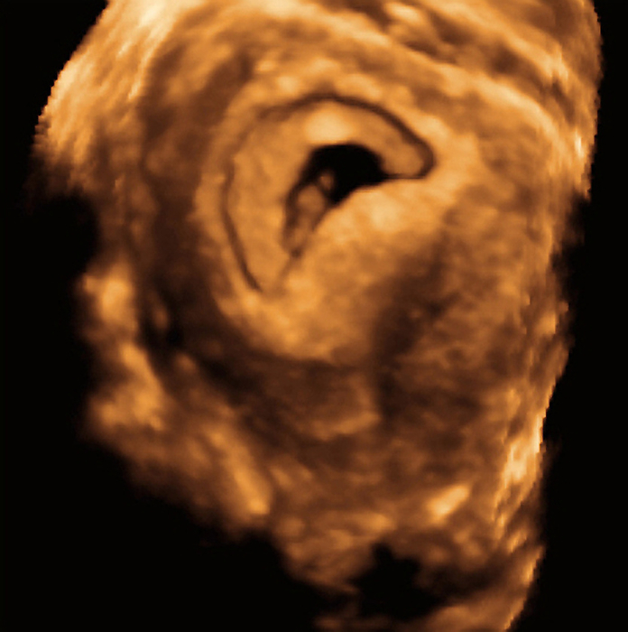 Embryo, 3 D ultrasound scan Embryo. Coloured 3 D ultrasound scan of a seven  week old embryo  upper center  in the uterus. Between weeks six and eight the face becomes recognisable, the trunk straightens, the tail disappears and the limbs become jointed. At this stage of development the embryo is around 2 centimetres long. Ultrasound scanning is a diagnostic technique that sends high frequency sound waves into the body via a transducer. The returning echoes are recorded and used to build an image of an internal structure. Foetal ultrasound scanning is routine during pregnancy. 3 D scanning uses computer technology to return more detailed images than conventional 2 D scans.