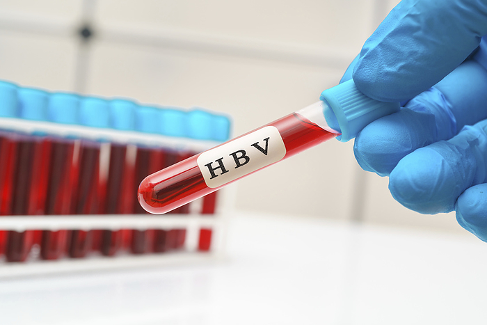 Hepatitis B virus blood test, conceptual image Hepatitis B virus blood test, conceptual image., Photo by WLADIMIR BULGAR SCIENCE PHOTO LIBRARY