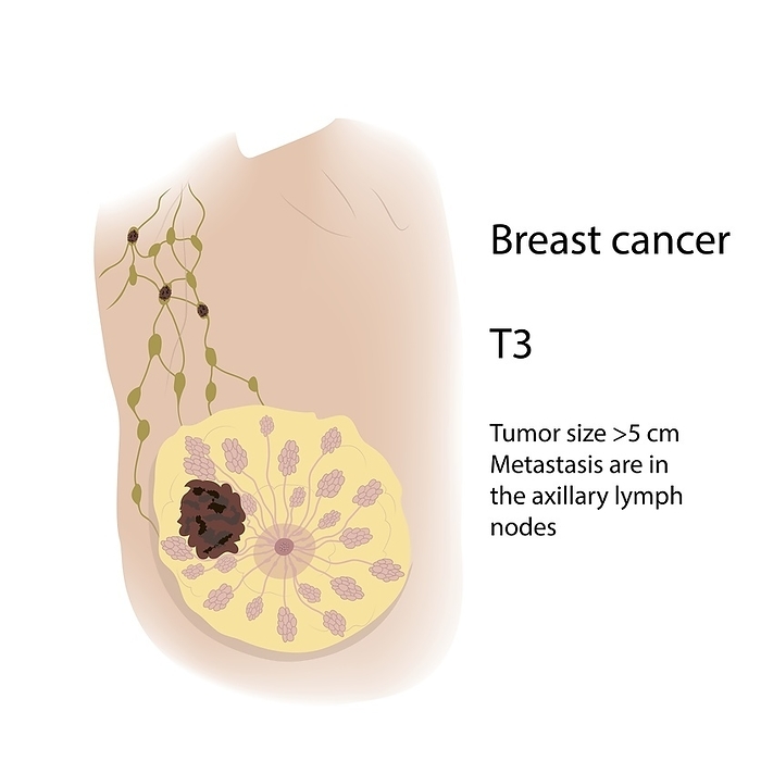 Breast cancer at stage T3, illustration Breast cancer at stage T3, illustration. Tumour size more than 5 centimetres and has spread  metastasised  to the axillary lymph nodes., Photo by VERONIKA ZAKHAROVA SCIENCE PHOTO LIBRARY