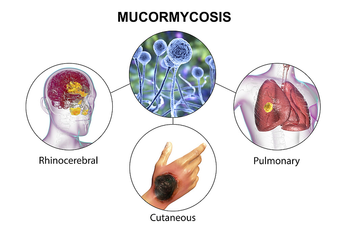 Clinical forms of mucormycosis, illustration Clinical forms of mucormycosis, a disease caused by Mucor sp. fungi, also known as black fungus, or bread mould, 3D illustration. Mucor sp. fungi are found in soil and decaying organic matter and are common indoor moulds. It can cause the rare but serious disease mucormycosis  zygomycosis  in patients that are immunocompromised or undergoing steroid therapy. The fungus can infect the lungs, sinuses, brain, gastrointestinal system, or the skin. In 2021 outbreaks of mucormycosis were seen in diabetic patients with Covid 19. Treatment is with antifungal drugs, although surgery is often needed to cut away the infected tissue., Photo by KATERYNA KON SCIENCE PHOTO LIBRARY