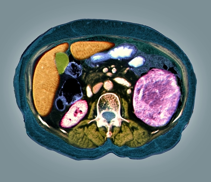 Kidney cancer, CT scan Kidney cancer. Coloured axial computed tomography  CT  scan through the abdomen of a 59 year old man with cancer of his left kidney  enlarged at right, pink . The cancer is nearly 9 centimetres across. It is a renal cell carcinoma, resulting in a large lesion and necrotic tissue. Cancer cells divide in an uncontrolled fashion and migrate to invade other tissues. Treatment is with surgery if the cancer is still localised, and chemotherapy and radiotherapy if it has spread., Photo by ZEPHYR SCIENCE PHOTO LIBRARY