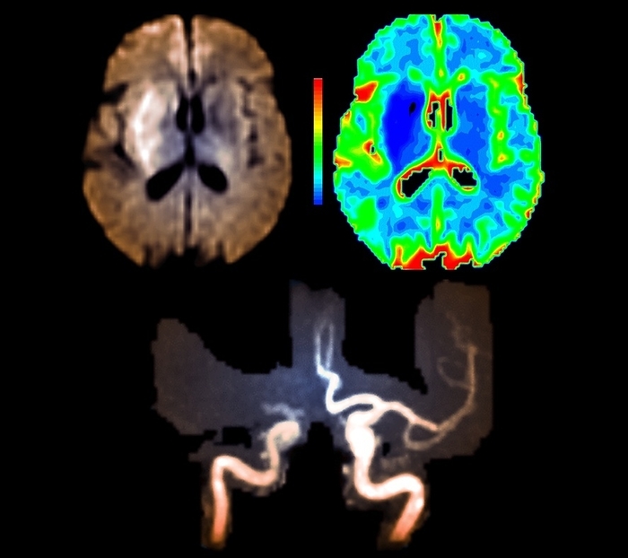 Brain damage due to a stroke, MRI scans Brain damage due to a stroke. Axial magnetic resonance imaging  MRI  scan  upper left , an apparent diffusion coefficient  ADC  MRI scan  upper right , and a magnetic resonance angiography  MRA  scan  bottom , showing damage  bright and blue areas  and blocked arteries in the right hemisphere of a 63 year old man s brain, caused by a stroke  cerebrovascular accident, CVA . The stroke caused hemiplegia  paralysis of one side of the body, here the left side . A stroke is where the brain is damaged due to hypoxia  lack of oxygen . This is usually due to an interruption or other damage to the blood supply, such as a burst blood vessel or a clot blocking the blood flow to the brain. These images were obtained 5.5 hours after the stroke, which was caused by a thrombosis  abnormal blood clot  blocking the internal right carotid artery., Photo by ZEPHYR SCIENCE PHOTO LIBRARY