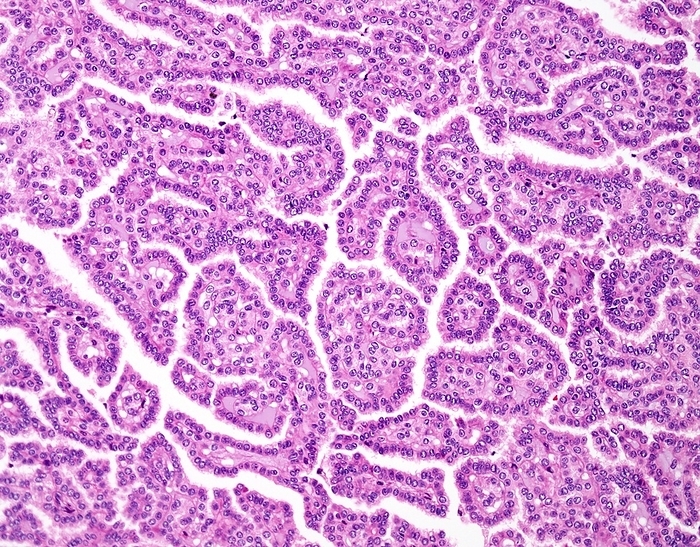 Papillary renal cell carcinoma, light micrograph Light micrograph of papillary renal cell carcinoma, type 1. The papillae are lined by a single layer of tumor cells. They are low grade tumors and generally present at an earlier stage than type 2 tumors., Photo by WEBPATHOLOGY SCIENCE PHOTO LIBRARY