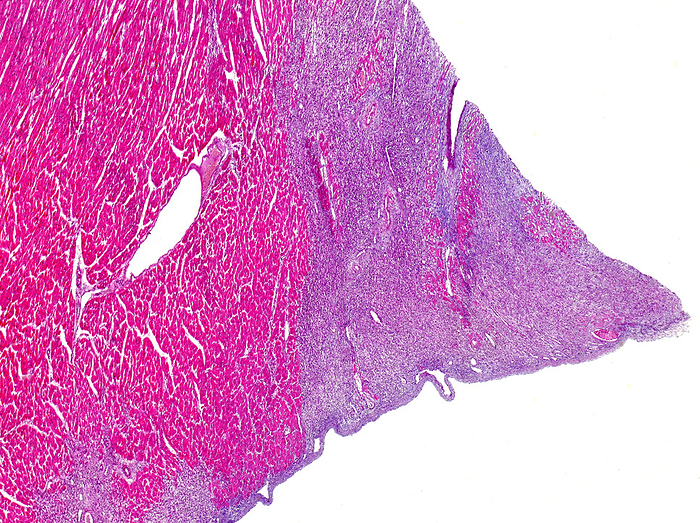 Infective myocarditis, light micrograph Light micrograph section through a human heart muscle showing infective myocarditis. Myocarditis is an inflammation of the heart muscle  myocardium . This can affect the heart muscle and the heart s electrical system, thereby, reducing the heart s ability to pump, causing rapid or abnormal heart rhythms  arrhythmias . A viral infection usually causes myocarditis, but it can result from a reaction to a drug or be a part of a more general inflammatory condition., Photo by NIGEL DOWNER SCIENCE PHOTO LIBRARY
