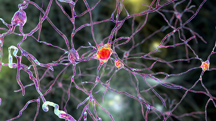 Brain neuron, illustration Neurons of the dorsal striatum, illustration. Dorsal striatum is a nucleus in the basal ganglia, degrading of its neurons plays crucial role in development of Huntington s disease., by KATERYNA KON SCIENCE PHOTO LIBRARY
